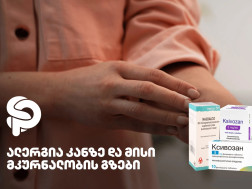 ალერგია